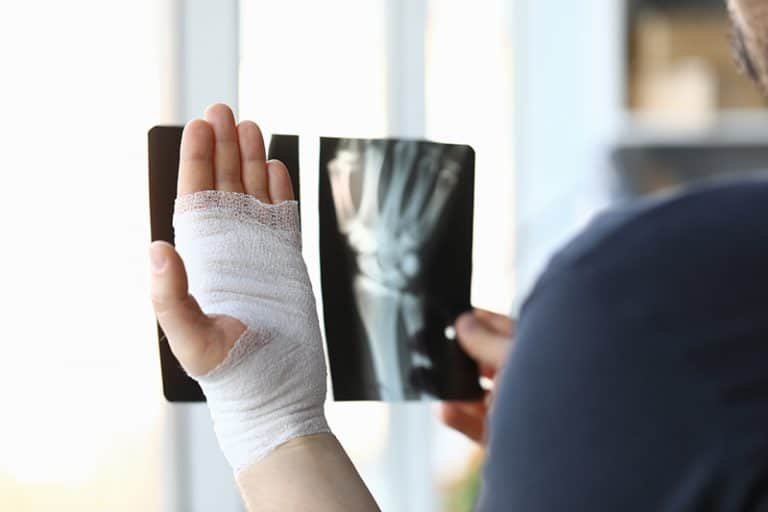 Read more about the article Fractures et l’huile de CBD : pour réduire la douleur et renforcer les os